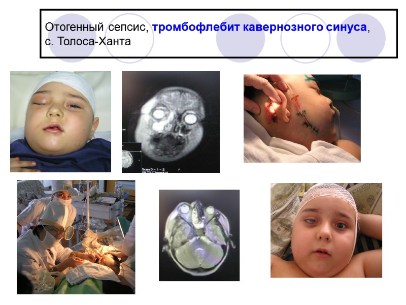 Отогенный сепсис, тромбофлебит кавернозного синуса,  с. Толоса-Ханта